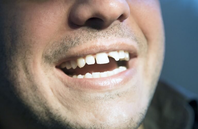 5 Details Dentists Match When Repairing A Chipped Front Tooth With Composite